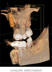 computer-aided-implant