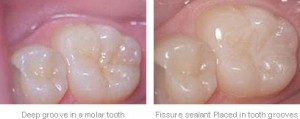 fissulesealant_img