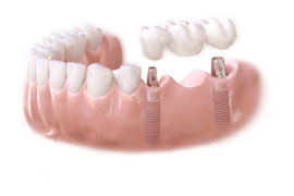 fixed-implant-bridge_img