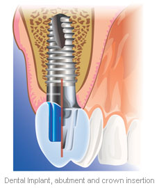 single-tooth-implants_img1