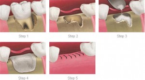 socket-preservation_img1